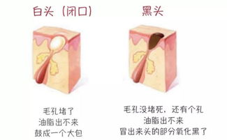 辨別黑頭與閉口，黑頭儀的正確使用與誤區(qū)